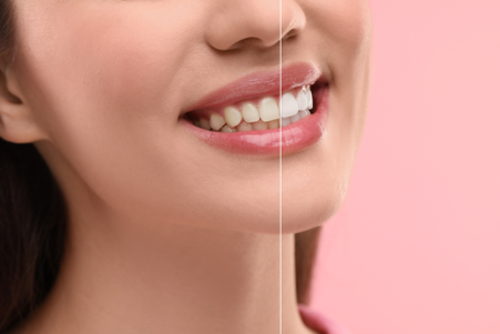 It’s not too late to save £45 on our Airflow dental treatment