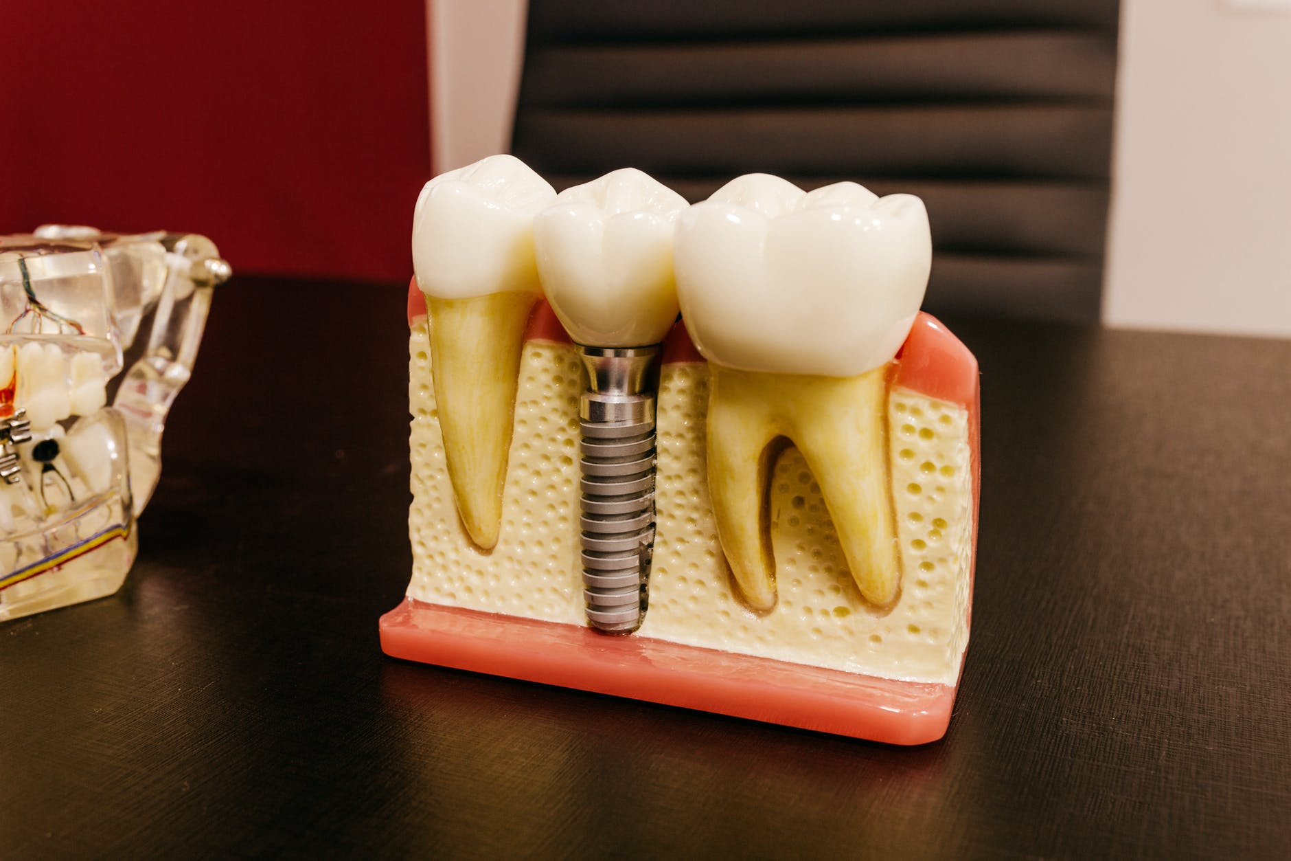 What are dental implants and are they suitable for you?